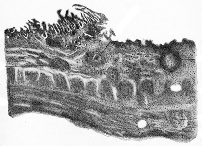 肠胃管状溃疡边缘刻有古老的插图图片