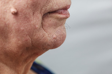 老年养恤金领取者女皮肤纤维瘤接近尾声老年养恤金领取者女皮肤纤维瘤接近尾声图片