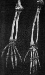 日本人和澳大利亚前臂和手的骨骼澳大利亚人老式刻字图集190年宇宙与人类图片