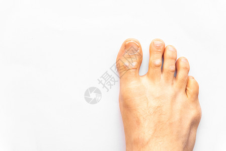 右脚感染了皮索里巴虫病人在足科医生孤立在白色背景图片