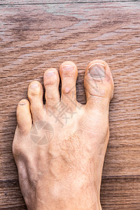 受皮肤问题影响的脚趾红皮疹产生丝虫病的斑块图片素材