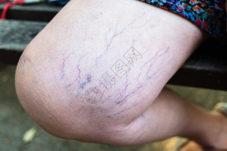 坐在座位上的女人腿血管变异图片素材