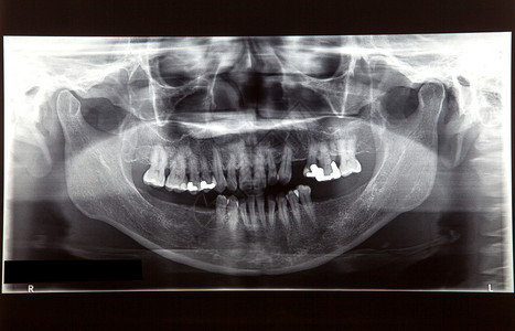 牙科护理概念的X光片图片