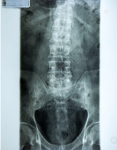 胸X光薄膜图片