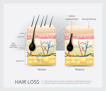 毛发损失结构矢量说明图片