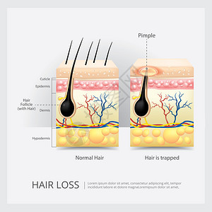 毛发损失结构矢量说明背景图片