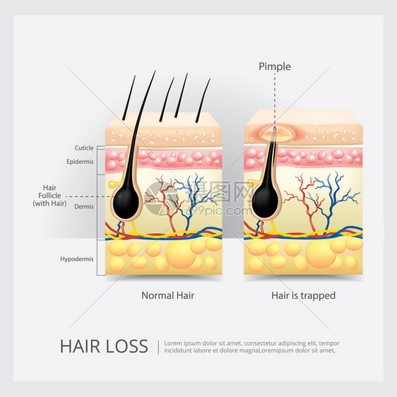 毛发损失结构矢量说明图片