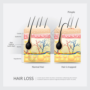 毛发损失结构矢量说明图片