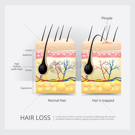 毛发损失结构矢量说明图片