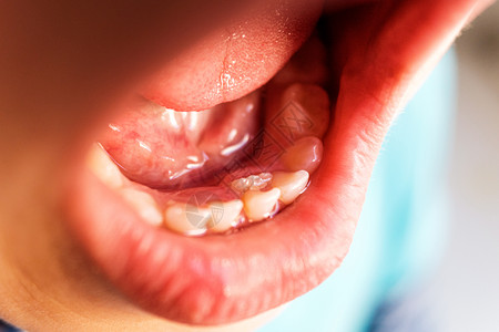 牛奶 小孩儿童鲨鱼牙第一颗出现在婴儿后面的童年时期comjoaquincorba