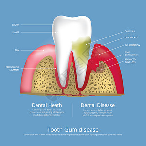 古姆疾病媒人类牙齿阶段说明图片