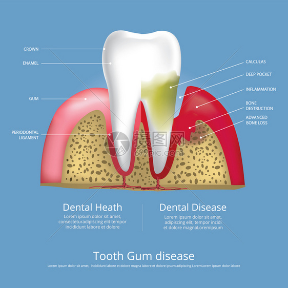 古姆疾病媒人类牙齿阶段说明图片
