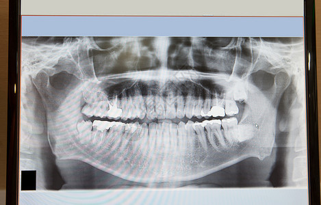 牙科护理概念的X光片图片