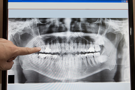 牙科护理概念的X光片图片