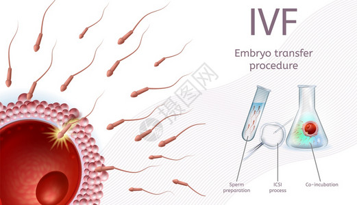 体外授精Embryo移植程序IVF过程图附有说明和标Sperm准备ICSI过程联合孵化现实矢量说明医疗容器体外授精EmplyoE背景图片