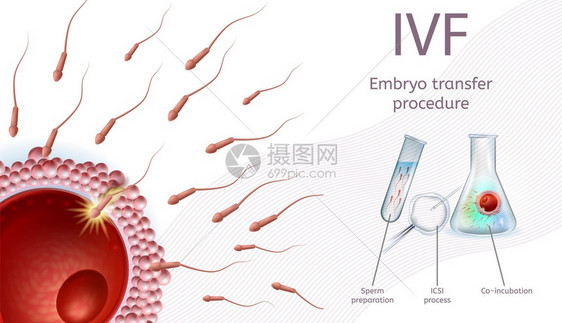 体外授精Embryo移植程序IVF过程图附有说明和标Sperm准备ICSI过程联合孵化现实矢量说明医疗容器体外授精EmplyoE图片