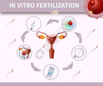 与舞台IVF图标相环绕的中心带有Uterus前视线的活体受精彩色海报Spermatozons流向雌卵细胞矢量现实说明Banner图片