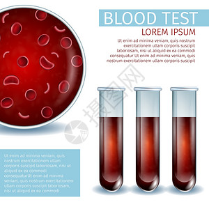 红色血液含有血红色细胞的宏视图以及带有液体血样本的一组实验室玻璃管子真实的矢量说明带有复制空间的广场血热医学禁闭器血液医学禁闭器复制空间插画