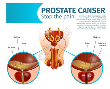 前列腺癌肿瘤细胞男泌尿生殖系统疾病健康和受感染器官现实的病媒解剖计划禁闭室复制空间止痛Gland的癌症肿瘤细胞图片
