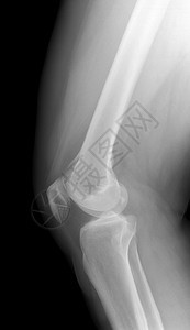 KneeXRay的图像检测放射科KneeOsteoarthyl炎图片