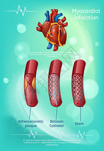 治疗和警告心脏病方法的禁止者活血液管说明心肌梗塞预防气球导管保健概念治疗心肌梗塞方法禁止者心肌梗塞方法禁止者背景图片