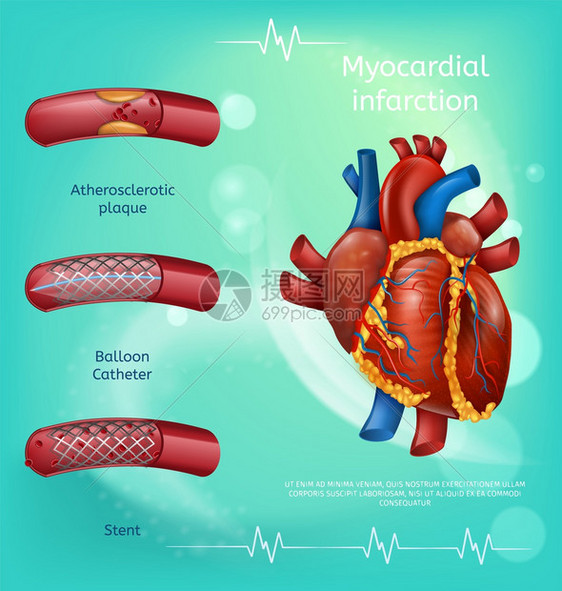 心肌梗塞血管液动脉球胃静病媒说明心脏预防概念诊所着陆页血管形象现实液管人类心脏图片