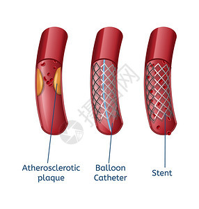 关闭船只解剖和现代方法气球导管和口服治疗病媒说明医技术保健概念消除神龙体硬化现实演示图片