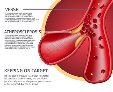 CrossCreatyRealisticAtherroscleraticsessions解剖矢量说明医疗心脏病风险导体指定血压增图片