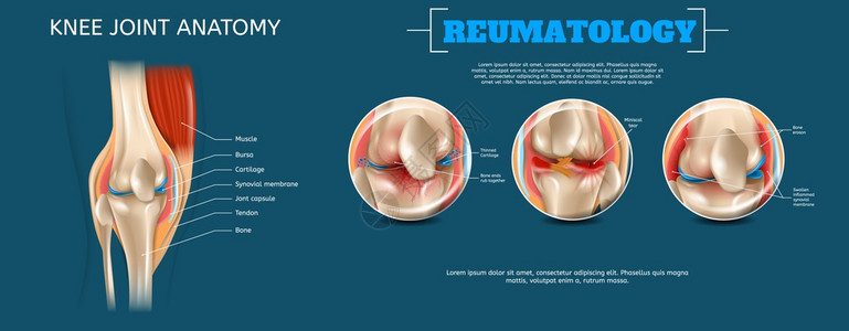 3d矢量再生图像组成要素结构人膝联合肌肉BursaCartilageSynovialMembraneJontCapsuleTen图片