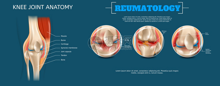 3d矢量再生图像组成要素结构人膝联合肌肉BursaCartilageSynovialMembraneJontCapsuleTen图片