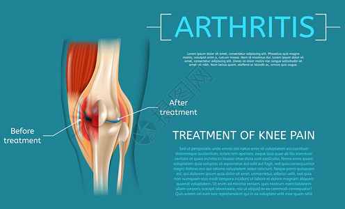 膝疼痛的现实说明治疗医福利示范结构在关节炎治疗前后和之的医学证明结构详细合编3d矢量图像Banner解剖人体膝盖图片