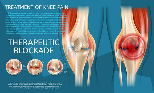 3d矢量图像Banner治疗裂缝人类膝关节在医疗治前后查看图片
