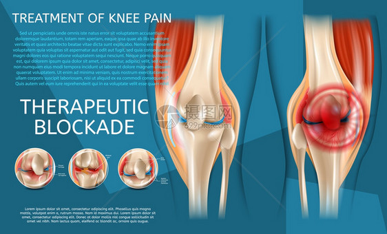 3d矢量图像Banner治疗裂缝人类膝关节在医疗治前后查看图片