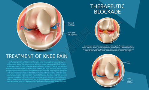 3d矢量图像Banner治疗裂缝人类膝关节在医疗治前后查看图片