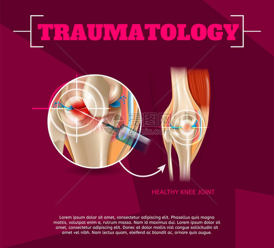 3dVectorBanner图像解剖人体膝盖联合治疗Osteoarthritis注射药物方法健康膝盖联合治疗结果图片