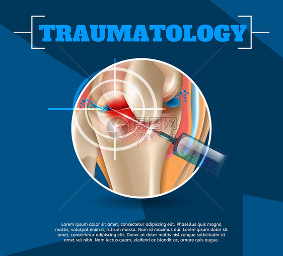 3dVectorBanner图像解剖人体膝盖联合治疗Osteoarthritis注射药物方法健康膝盖联合治疗结果图片