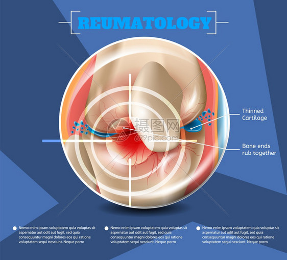 3d矢量图像导体解剖医学结构类型伤害和人体膝盖疾病联合骨结瘦化工厂图片