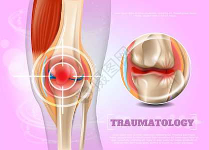 膝盖解剖3dBannerVictor图像闭合解剖和人体膝盖结构联合InfographicsResearchProblemsandpain插画