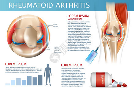 3dBannerVictorI说明人体膝盖联合疾病信息治疗药物注射以缓解疼痛图片