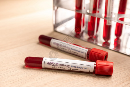 新冠19血液样本测试2019nCoV新冠化验室检查图片