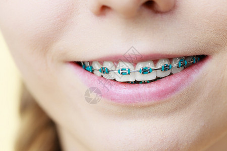 关闭妇女笑着用蓝色牙套显示齿的妇女关闭牙齿用套图片