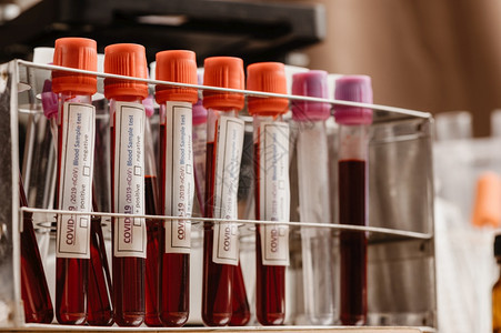 在试管中进行新冠19血液测试为诊断新的科罗纳感染2019年新科罗纳疾进行血液检测样本图片