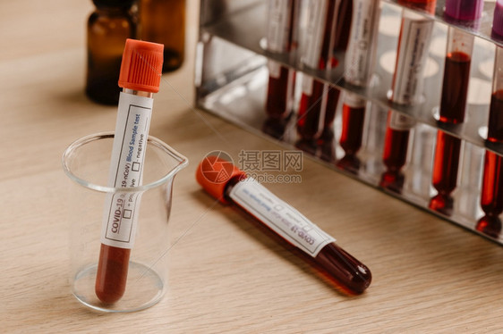 新冠19测试和化验室血样本用于诊断具有实验室背景的新科罗纳感染2019年新科罗纳疾2019年新科罗纳的血液检测图片