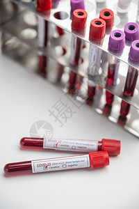 含有血液样本的清冠状新冠19管的存在血液测试样本已经检测出冠状呈阳图片