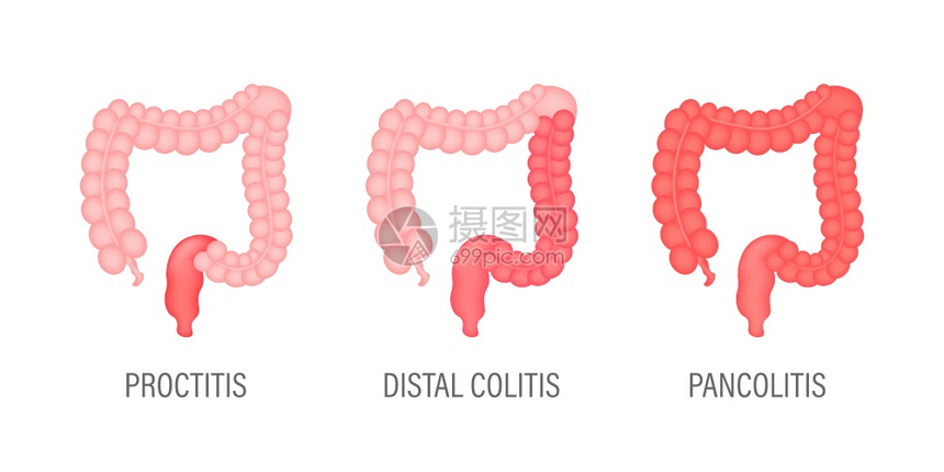 医疗设计科肠胃疾病学便秘图标设计保健病媒存量图解胃肠病学道疾图解口腔便秘标设计病媒存量图解图片