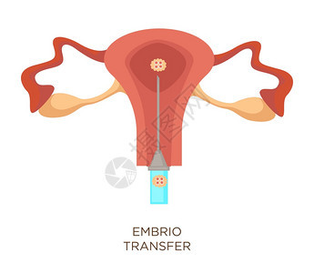 Uterus和胚胎转移人工授精孤立女器官体外授精孕育现代医药注射器和生殖系统外科手术胚胎转移人工授精子宫和卵孤立器官图片
