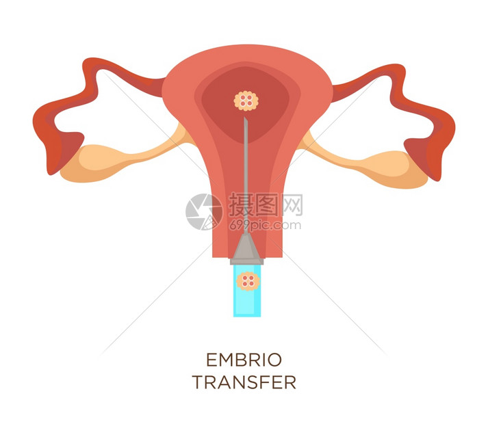 Uterus和胚胎转移人工授精孤立女器官体外授精孕育现代医药注射器和生殖系统外科手术胚胎转移人工授精子宫和卵孤立器官图片