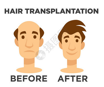 在手术之前和后进行头发移植手术的秃头人和有发型病媒的秃头人与有孤立格的秃头人解决男美容发型手术和fut技处理问题图片