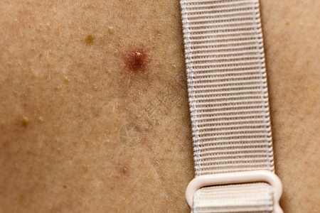 皮肤上近处有丙烯酸和红斑点健康问题皮肤疾病上近处有丙烯酸和红斑点皮肤上近处有丙烯酸和红斑点图片