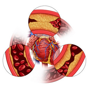 心脏动脉疾病和冠状体医学概念是逐渐形成的板块造堵塞的动脉和无神体硬化与带有3D插图元素的胆固醇人体解剖一样图片